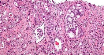 Micrograph showing prostatic acinar adenocarcinoma, which is the most common form of prostate cancer
