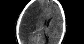 CT scan slice of the brain showing a right-hemispheric ischemic stroke (left side of image).