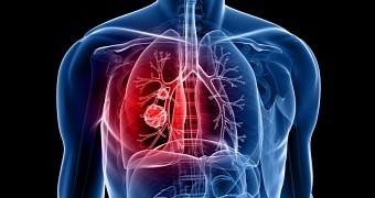 New study shows how lung cancer spreads through the body