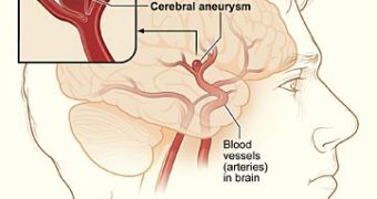 Revolutionary Approach to Aneurysms: Through the Nose