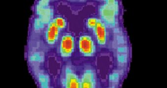 PET scan of a human brain with Alzheimer's disease
