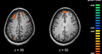 Image showing brain areas more active in controls than in schizophrenia patients during a working memory task during a fMRI study. Two brain slices are shown