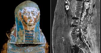 A high-resolution CT scan of the lumbar spine region of a 2150-year-old Egyptian mummy has just revealed small, round lesions—the oldest case of metastatic prostate cancer in ancient Egyptians