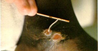 A Guinea worm being rolled out from a pustula