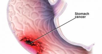 Simple Breath Test Might Help Detect Stomach Cancers