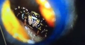 This is an actual image of the spider in Katie Melua's ear, as seen on the monitor in the doctor's office