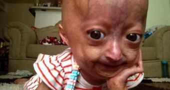 Adalia Rose supports the progeria research cause