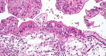 Some Ovarian Cancers Caused by Genetic Mutation
