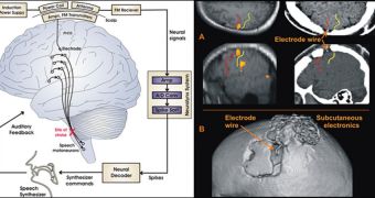 A schematic at left and CT scans at right of the wireless brain-computer interface