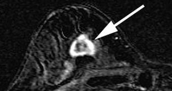 An MRI scan from a 55-year-old woman. The arrow points to a lesion, later confirmed to be invasive breast cancer
