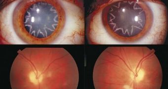 Man develops star-shaped cataracts after being electrocuted