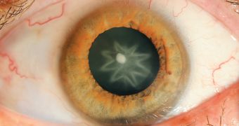 Man who got hit in the eye develops star-shaped cataract