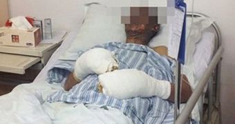 The Chinese pensioner had his face disfigured because of the blast