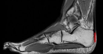An MRI of a distance runner's foot and ankle shows a heel bone sized to pull the Achilles tendon taut, a condition that researchers say applied to Stone Age humans