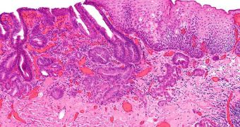 This micrograph shows esophageal cancer