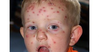 Study: 2 Vaccine Doses Protect Kids from Chickenpox