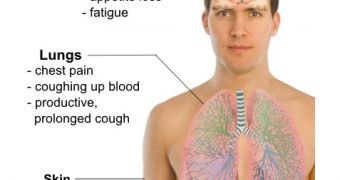 Symptoms of pulmonary tuberculosis.