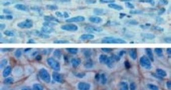 Cancer cells in tumors treated with salinomycin have a less malignant appearance (top) and look more like differentiated cells than untreated cells (bottom)