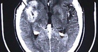 Survivors of Childhood Cancers Have High Long-Term Risk of Strokes