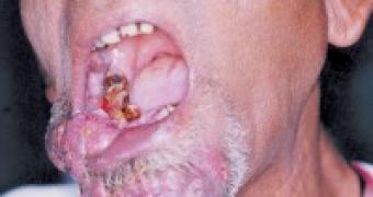 Snus consumption has been linked to such oral cancers