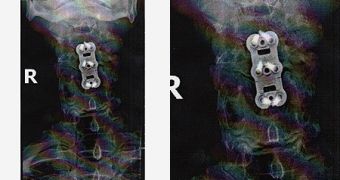 Sylvester Stallone posts X-rays of the bolts he got for the neck injury sustained on “The Expendables”
