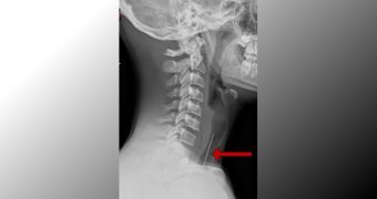 X-ray reveals dart caught in teen's airway
