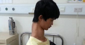 Teenager in China hopes doctors will manage to shorten his neck