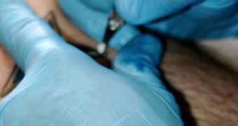 Many young adults who want to get tattoos are unaware of the risk associated with tattoo removal