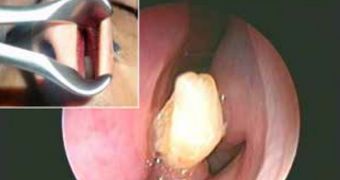 Doctors shocked to find a tooth inside a man's nose