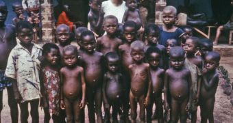Many of these children have kwashiorkor