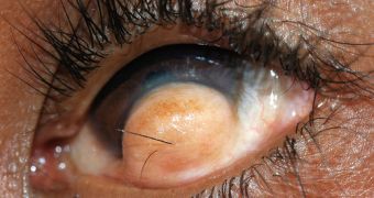 Rare tumor makes hair grow on a man's eyeball