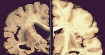 Brain sections: healthy hemisphere (right), hemisphere of patient suffering from Alzheimer's (left)