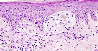 This micrograph image shows melanoma skin cancer