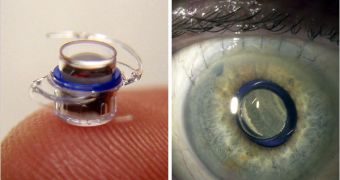 Left: the microscope implant, in real size. Right: the device implanted in the actual eye