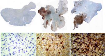 The Chronic Traumatic Encephalopathy study focuses on unusual concentrations of Tau protein, shown here as brown spots. The more brown spots, the greater the brain damage.