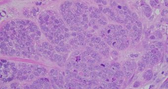 Cancer tumors shed cells of considerable genetic diversity