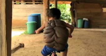 “Turtle Shell” boy now leads a fairly normal life
