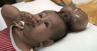 Doctors operate on "two-headed" boy born in India