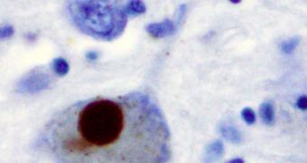 Positive α-synuclein staining of a Lewy body in a patient with Parkinson's disease