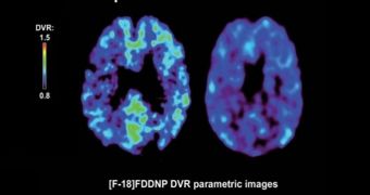 PET scans show higher FDDNP binding (yellow areas) and thus more abnormal proteins in a patient with major depressive disorder compared with a healthy control