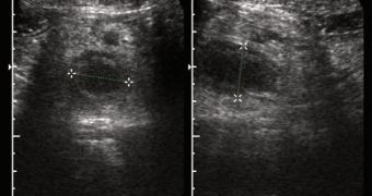 An ultrasound scan, showing an engorged appendix