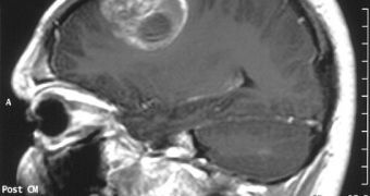 Gliobastoma (astrocytoma) WHO grade IV - MRI sagittal view, post contrast. 15 year old boy.