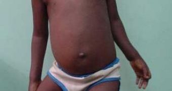 Rickets in children is caused by low levels of vitamin D