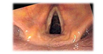 An image of the human voice box, taken with an endoscope. The vocal folds are clearly visible
