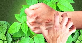 Watch: How and Why Poison Ivy Causes Insufferable Rashes