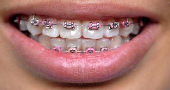 Wearing fake braces is a trend in Asia