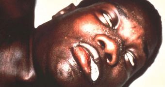 Man in the final stage of sleeping disease
