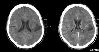 Gliomas are some of the most aggressive and fast-spreading forms of brain cancer around