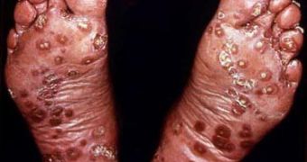 Skin cancer in feet