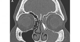 A woman's implant slides up, gets stuck in the sinus cavity